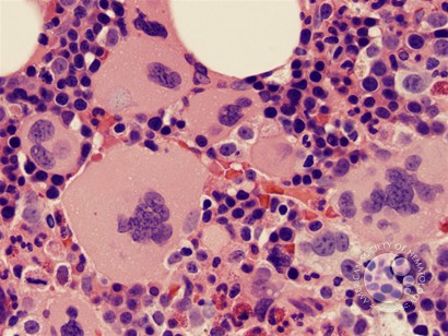 Myelofibrosis and Megakaryocyte Clustering - 4.