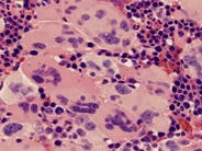 Myelofibrosis and Megakaryocyte Clustering - 5.