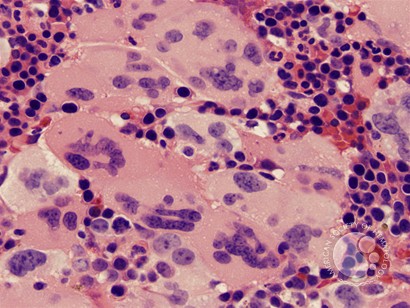 Myelofibrosis and Megakaryocyte Clustering - 5.