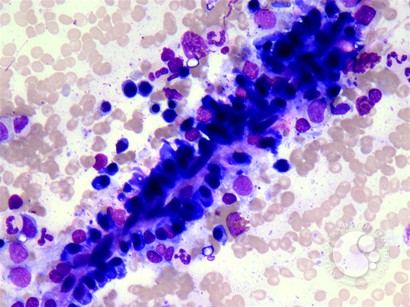 Normal Plasma Cell Distribution Along Bone Marrow Sinusoid - 1.