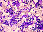 What is Bone Marrow? - CLL Society