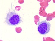 Reactive Histiocytes in the Peripheral Blood - 2.