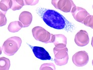Splenic Marginal Zone Lymphoma With Villous Lymphocytes – Peripheral Blood - 6.