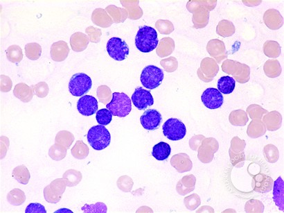 Precursor B-cell Acute Lymphoblastic Leukemia - 1.