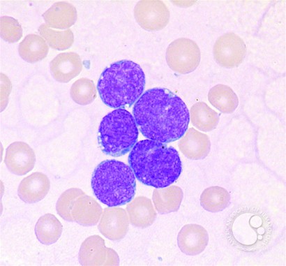 Precursor B-cell Acute Lymphoblastic Leukemia - 2.