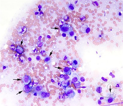 Anaplastic Large Cell Lymphoma Involving the Bone Marrow - 1.