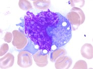 Anaplastic Large Cell Lymphoma Involving the Bone Marrow - 2.