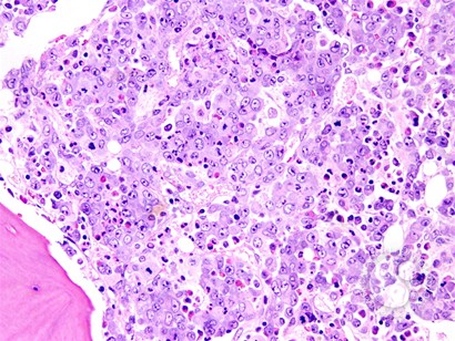 Anaplastic Large Cell Lymphoma Involving the Bone Marrow - 3.