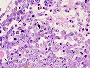 Anaplastic Large Cell Lymphoma Involving the Bone Marrow - 4.