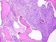 Anaplastic Large Cell Lymphoma Involving the Bone Marrow - 5.