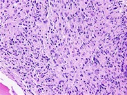 Anaplastic Large Cell Lymphoma Involving the Bone Marrow - 6.