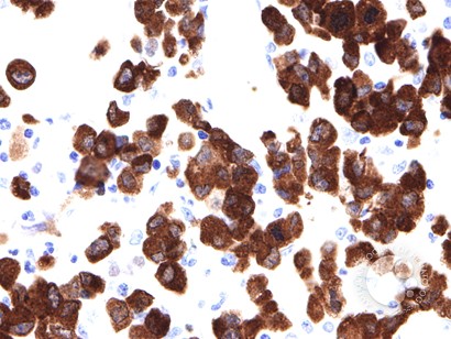Anaplastic Large Cell Lymphoma Involving the Bone Marrow - 7.