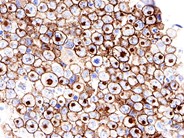 Anaplastic Large Cell Lymphoma Involving the Bone Marrow - 8.