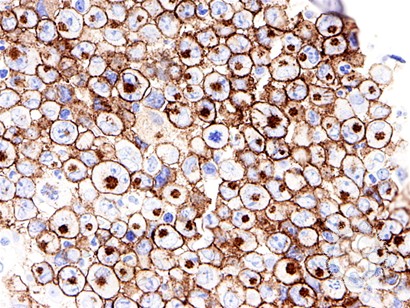 Anaplastic Large Cell Lymphoma Involving the Bone Marrow - 8.