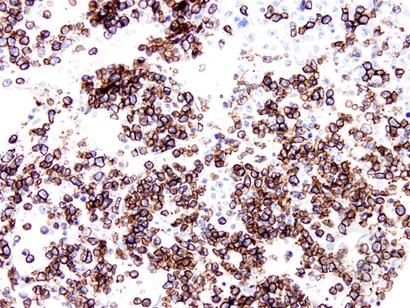 Anaplastic Large Cell Lymphoma Involving the Bone Marrow - 9.