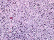 Anaplastic Large-Cell Lymphoma – Nodal Involvement - 2.