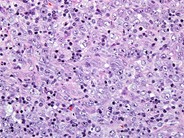 Anaplastic Large-Cell Lymphoma – Nodal Involvement - 3.