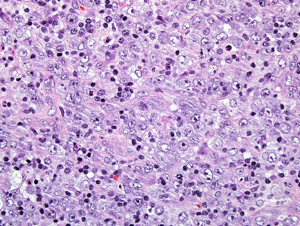 Anaplastic Large-Cell Lymphoma – Nodal Involvement - 3.