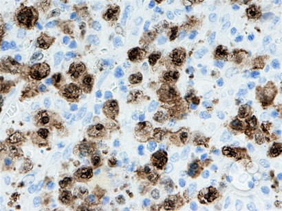 Anaplastic Large-Cell Lymphoma – Nodal Involvement - 4.