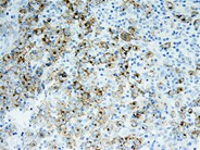 Anaplastic Large-Cell Lymphoma – Nodal Involvement - 5.