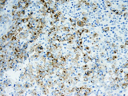 Anaplastic Large-Cell Lymphoma – Nodal Involvement - 5.