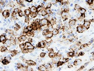 Anaplastic Large-Cell Lymphoma – Nodal Involvement - 6.