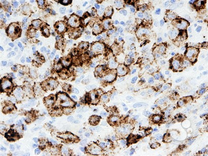 Anaplastic Large-Cell Lymphoma – Nodal Involvement - 6.