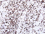 Anaplastic Large-Cell Lymphoma – Nodal Involvement - 7.