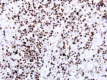Anaplastic Large-Cell Lymphoma – Nodal Involvement - 7.