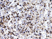 Anaplastic Large-Cell Lymphoma – Nodal Involvement - 8.