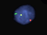 Anaplastic Large-Cell Lymphoma – Nodal Involvement - 9.