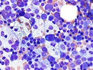 Marrow Histiocytosis - 2.