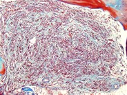 Bone Marrow Fibrosis - 3.