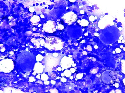 Megakaryocytic Hyperplasia - 1.