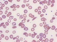 Pappenheimer Bodies in Sickle Cell Disease - 2.