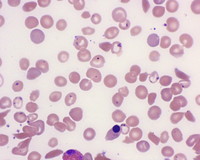 Pappenheimer Bodies in SCD