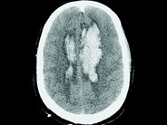 CNS Hemorrhage in APL - 1.