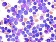 Peripheralizing Follicular Lymphoma with Atypical Morphology - 6.