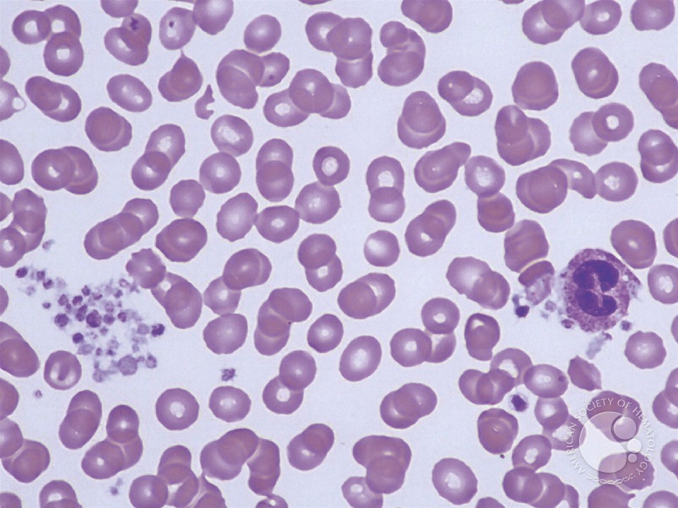 Leukocyte Phagocytosis of Platelets - 1.