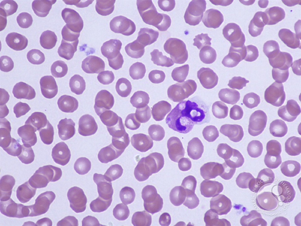 Leukocyte Phagocytosis of Platelets - 4.