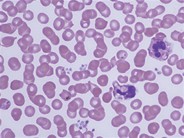 Leukocyte Phagocytosis of Platelets - 5.