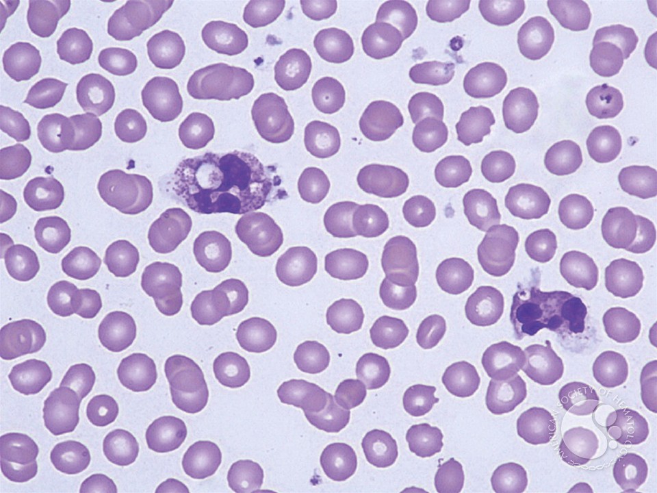 Leukocyte Phagocytosis of Platelets - 6.