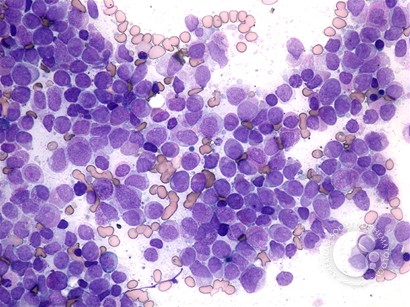 Acute promyelocytic leukemia - 1.