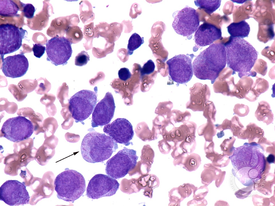 Acute promyelocytic leukemia - 2.