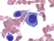 Metastatic bladder carcinoma - 2.