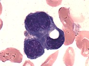 Metastatic adenocarcinoma of the colon - 1.