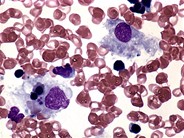 Familial hemophagocytic lymphohistiocytosis - 1.