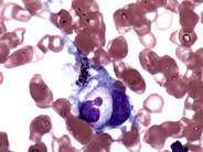 Familial hemophagocytic lymphohistiocytosis - 2.