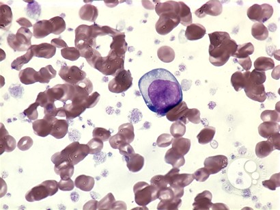 AML with t(3;3)-peripheral blood - 1.