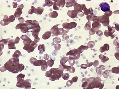 AML with t(3;3)-peripheral blood - 2.